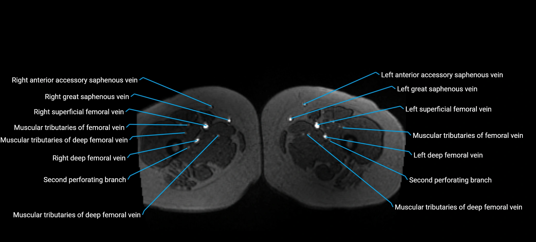 MRV abdomen pelvis & lower limb axial cross sectional anatomy labelled MRI image 233.webp